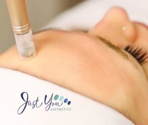 microneedling treatment
