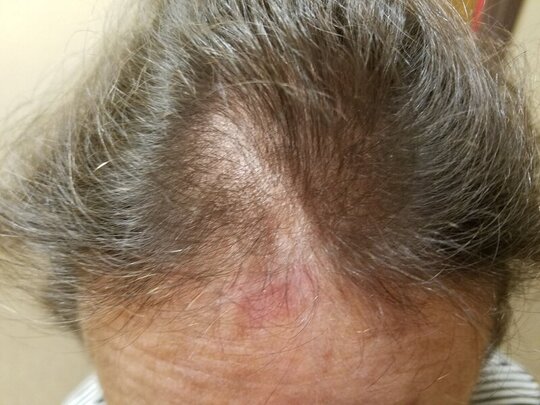 photo of a womans hair suffering from menopausal hair thinning